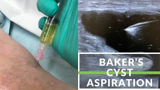 Draining fluid from knee [upl. by Akered]