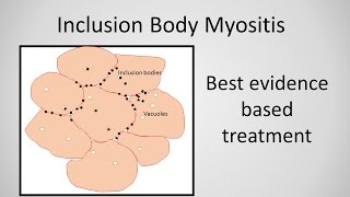 Myositis Exercises Introduction 1 1 [upl. by Guillema840]