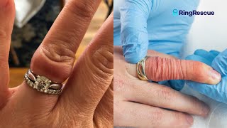 ANGRY FINGER Stuck Ring Removal Using The Ring Rescue Compression Device [upl. by Lorelle]