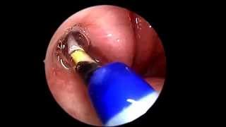 Eustachian Tube Balloon Dilation [upl. by Neliac]