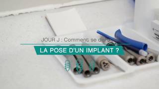 Comment se déroule la pose dun implant [upl. by Zirkle337]