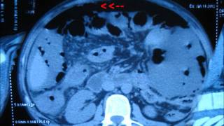 Bowel perforation CT scan features [upl. by Edmonds]