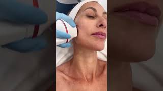 Radiofrecuencia facial [upl. by Catina]