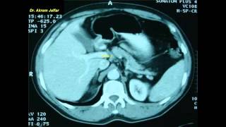 Cross sectional and imaging anatomy of the abdomen [upl. by Zamora]