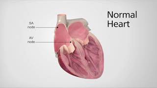 Normal Heart vs Heart in AFib [upl. by Drain421]