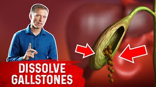 Do This to Help Dissolve Gallstones [upl. by Jarietta]