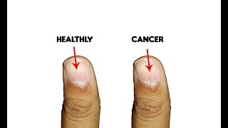 9 Fingernails serious alarming health issues and probllems [upl. by Lleryd398]