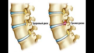 Лечение грыж позвоночника пиявками [upl. by Biebel]