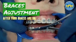 How Do Braces Straighten Teeth [upl. by Atnicaj]