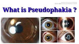 What is pseudophakia  sign  Intraocular lens  sharp vision [upl. by Nerraf]