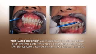 Desensitizing Procedure using the NEW TEETHMATE DESENSITIZER from Kuraray [upl. by Navek]