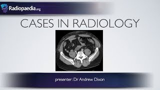 Cases in Radiology Episode 5 trauma CT abdomen [upl. by Howund]