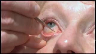 Oculoplastics basic exam Lacrimal system examination [upl. by Ayian]