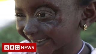 Yemen conflict Sixyearold Yusra’s new eye  BBC News [upl. by Ahsekal]