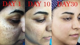 How I Got Rid of Dark Scars Hyperpigmentation PimplesAcne [upl. by Ahsas]