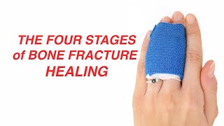 The Four Stages of Bone Fracture Healing [upl. by Osman]