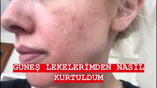 EYLÜL ÖZTÜRKGÜNEŞ LEKELERİMDEN NASIL KURTULDUMCİLTBAKIMI [upl. by Agostino]