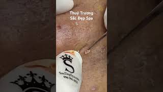 Acne Treatment thuytruong sacdepspa [upl. by Niggem769]