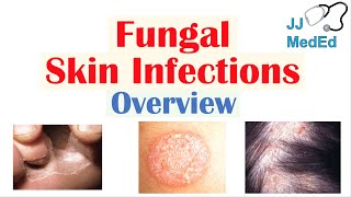 Overview of Fungal Skin Infections  Tinea Infections [upl. by Akiria207]