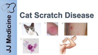 Cat Scratch Disease  Causes Symptoms and Treatment [upl. by Zaraf396]