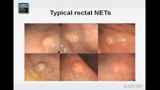 The Morphologic Assessment of Rectal Neuroendocrine Tumors [upl. by Maillil]