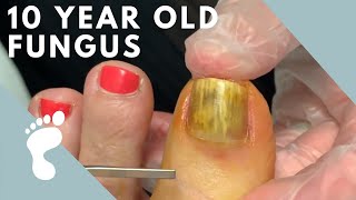 Fungus Takes Over Toenail  Toenail Removal [upl. by Bennir]