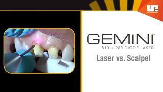 Gemini Clinical – Gingivectomy [upl. by Auhsaj]