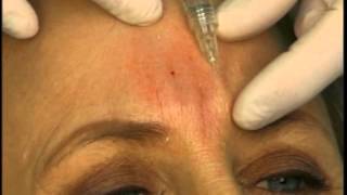 Dr Elliott Shows How to Fill Frown Glabella Lines With A Dermal Filler [upl. by Assenej]