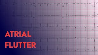 Atrial Flutter  EKG ECG Interpretation [upl. by Enatan]