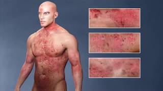 Atopic Dermatitis eczema From the Inside Out [upl. by Norvell]