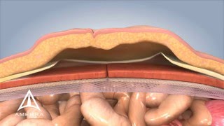 Ventral Hernia Repair  3D Medical Animation [upl. by Aham]