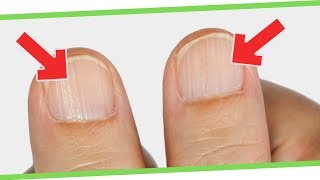 8 ALARMING Things Your Nails Is Warning You About Your HEALTH ⚠️💅 [upl. by Betty]