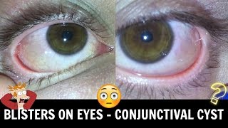 Emil Ennis Conjunctival Nevus Removal Surgery at Assil Eye Institute of Los Angeles [upl. by Eltrym12]