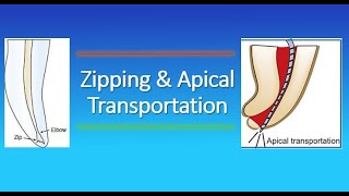 Zipping and Apical Transportation in Endodontics [upl. by Nolla99]