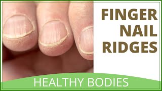 Fingernail Ridges  What Causes Nail Ridges amp How To Treat [upl. by Ngo]