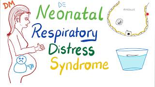 Neonatal Respiratory Distress Syndrome NRDS  Pediatrics  Pulmonology [upl. by Ekyt]