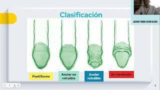 Fimosis y Parafimosis Equipo 2 [upl. by Ettedo205]