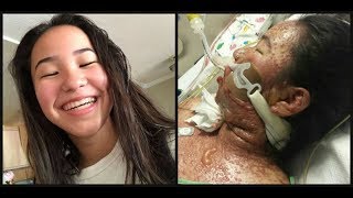 LA teenager’s skin melts’ off in severe reaction to prescription medication with strict FDA warning [upl. by Portuna935]