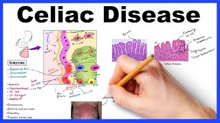 Celiac disease  Pathophysiology Symptoms Histology Diagnosis amp Management [upl. by Zeeba]