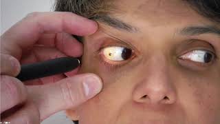 What is Thyroid Eye Disease TED [upl. by Kain]